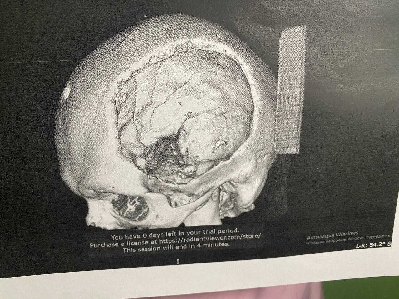 Белгородские врачи впервые провели уникальную пластическую операцию с 3D-пластиной на черепе